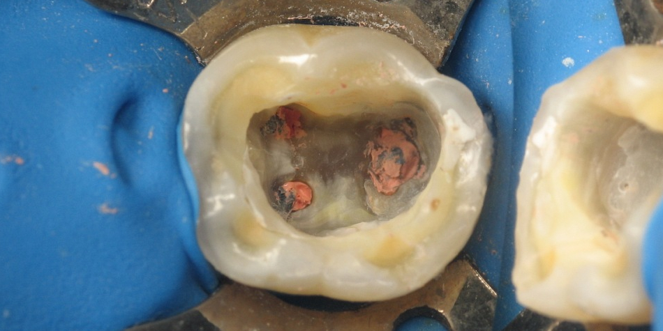 Лечение каналов зуба под микроскопом с наложением пломбы - фото №2