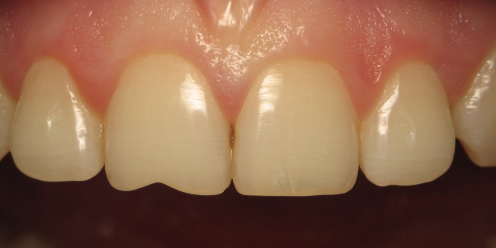 Восстановление скола переднего зуба - фото №1