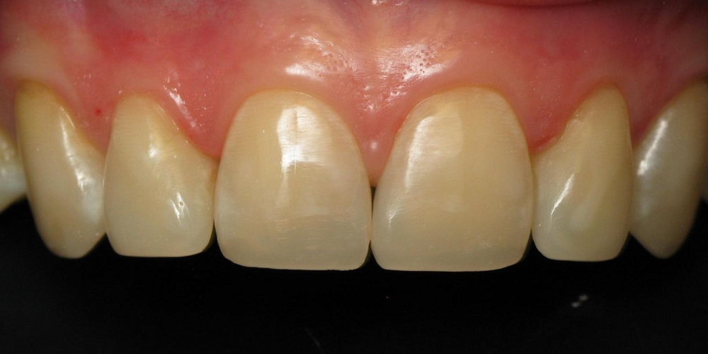 Восстановление скола переднего зуба - фото №2