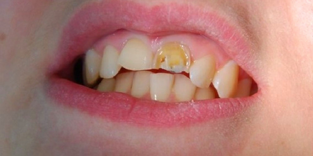 Установка двух безметалловых коронок E Max на 2 передних зуба - фото №1