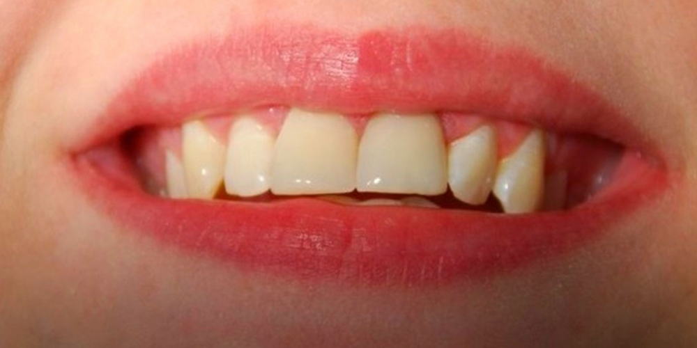 Установка двух безметалловых коронок E Max на 2 передних зуба - фото №2