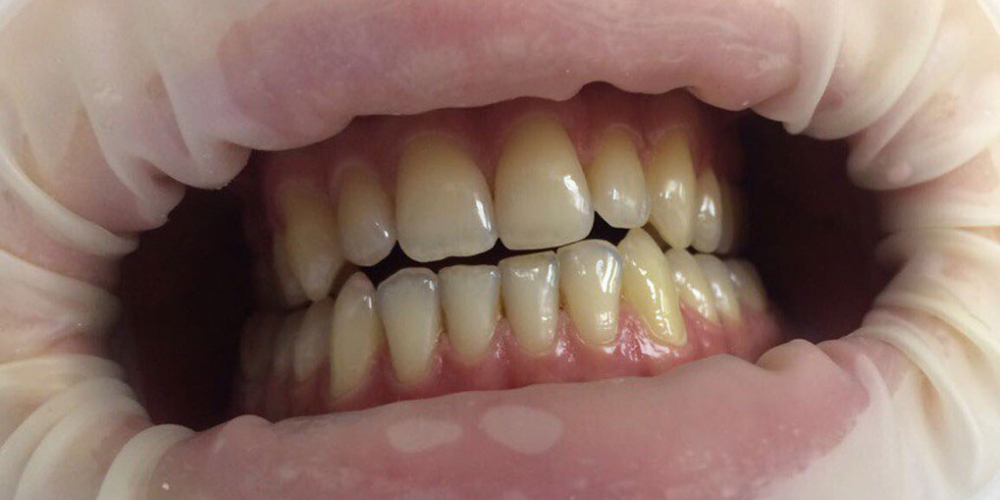 Результат отбеливания зубов системой Smileffect - фото №1