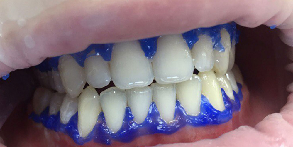 Результат отбеливания зубов системой Smileffect - фото №2