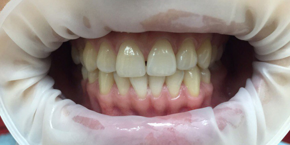 Результат отбеливания зубов системой отбеливания Smileffect у девушки - фото №1