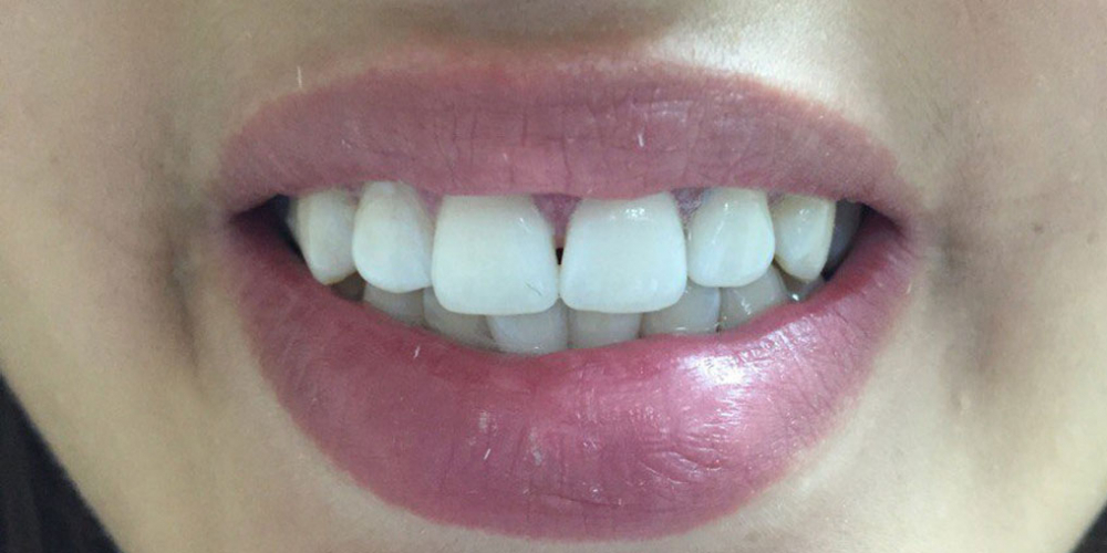 Результат отбеливания зубов системой отбеливания Smileffect у девушки - фото №2