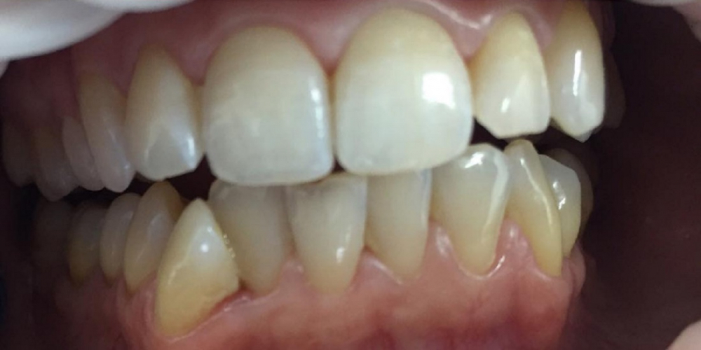 Результат отбеливание зубов системой Smileffect - фото №1