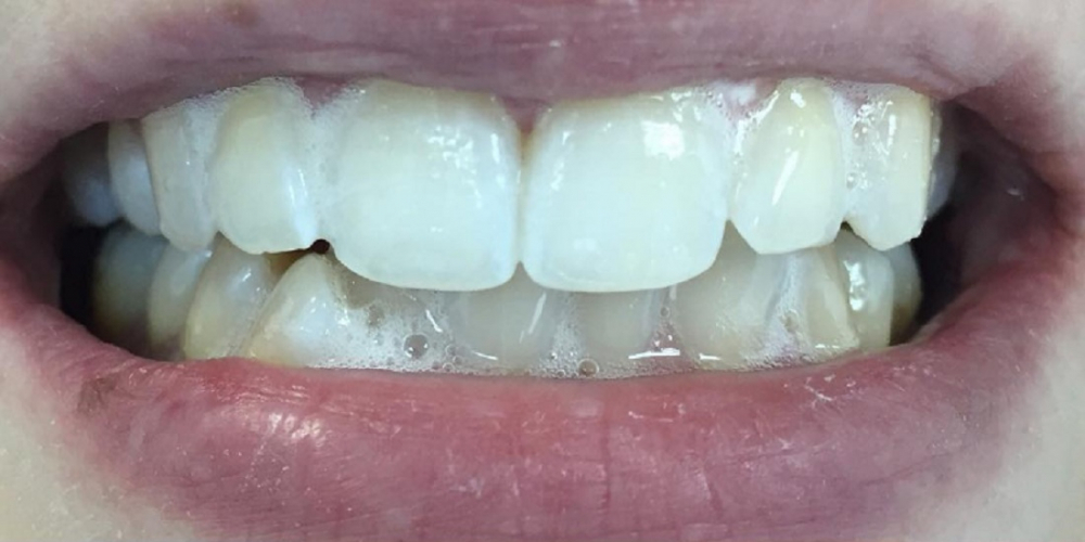 Результат отбеливание зубов системой Smileffect - фото №2