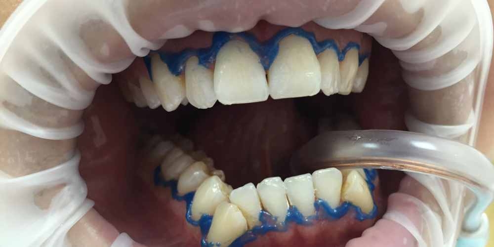Отбеливание зубов системой Smileffect - фото №1