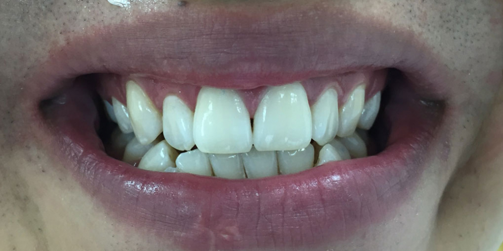 Отбеливание зубов системой Smileffect - фото №2