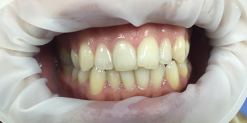 Результат отбеливания зубов системой отбеливания Smileffect - фото №1