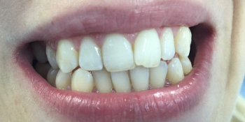 Результат отбеливания зубов системой отбеливания Smileffect - фото №2