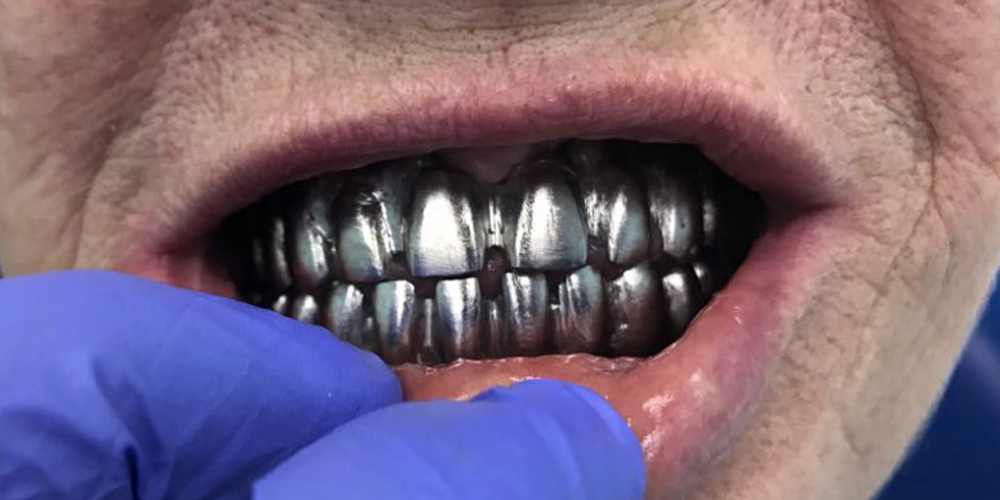 Восстановление зубного ряда нижней и верхней челюстях на имплататах - фото №1