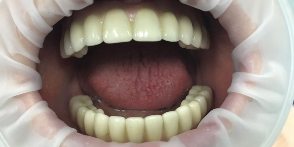Восстановление зубного ряда нижней и верхней челюстях на имплататах - фото №2