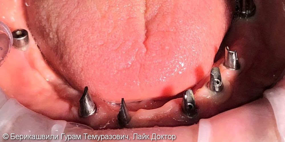 Восстановление зубного ряда на верхней челюсти при полной адентии с помощью имплантантов SNUCONE - фото №1