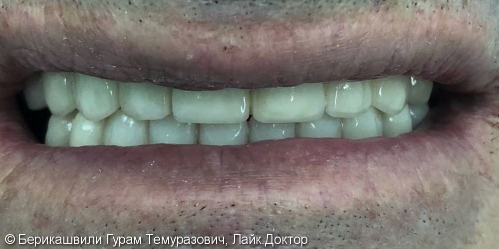 Восстановление зубного ряда на верхней челюсти при полной адентии с помощью имплантантов SNUCONE - фото №6