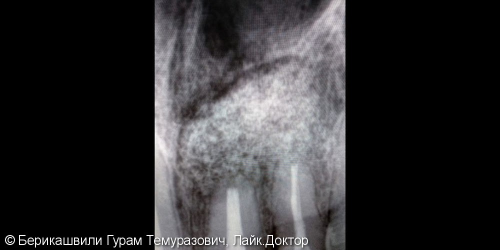 Резекция верхушки корней 2 зубов, рентген до и после - фото №1