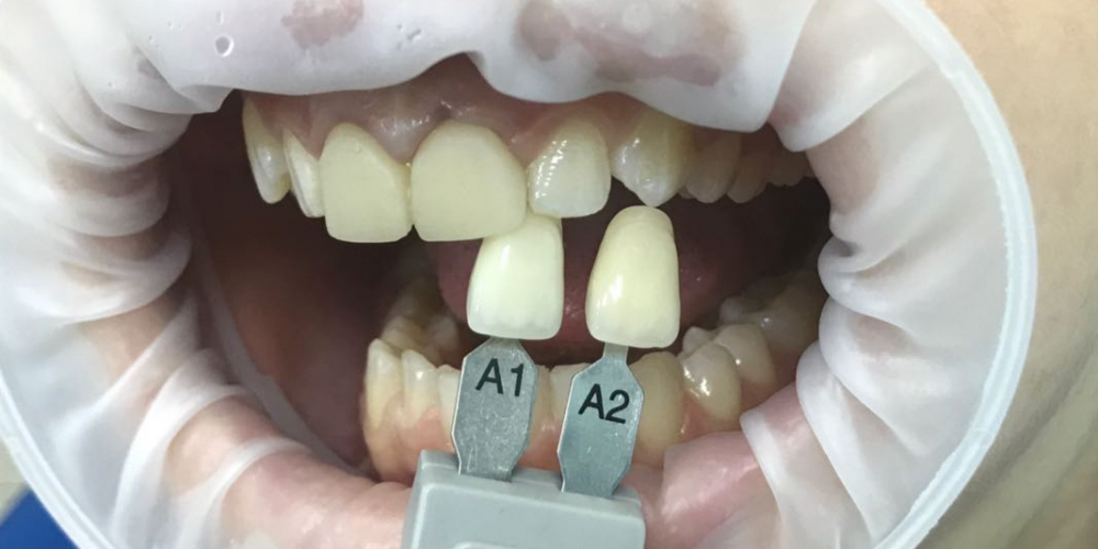 Коронки E-max на два передних зуба на верхней челюсти - фото №1