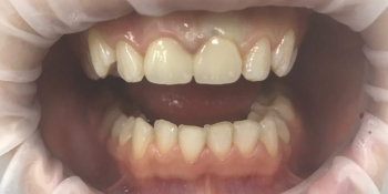 Коронки E-max на два передних зуба на верхней челюсти - фото №2