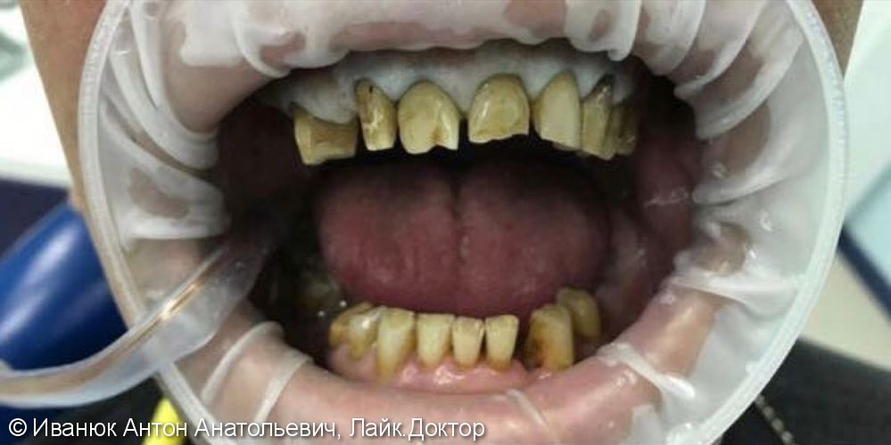 Исправление зубного ряда металлокерамическими коронками, до и после - фото №1