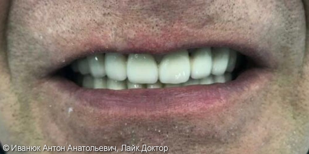 Исправление зубного ряда металлокерамическими коронками, до и после - фото №2