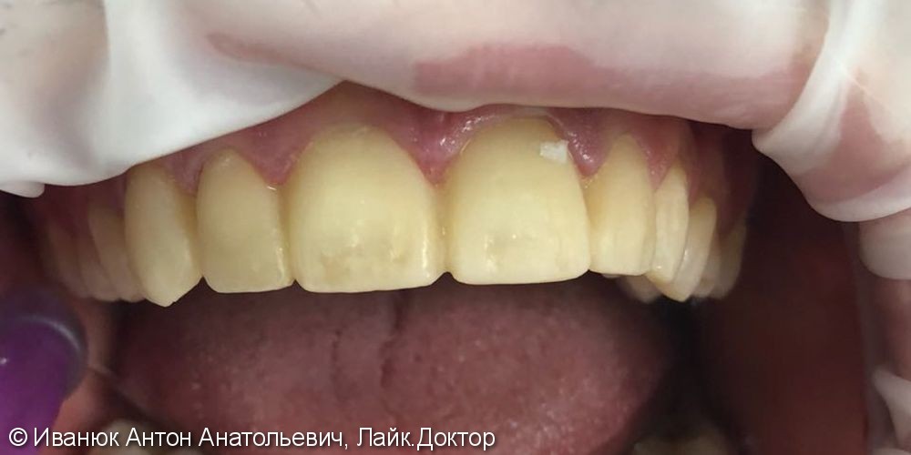 Протезирование зубов фронтального отдела с помощью виниров из прессованной керамики E-MAX - фото №1