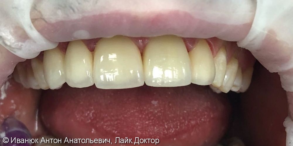 Протезирование зубов фронтального отдела с помощью виниров из прессованной керамики E-MAX - фото №3