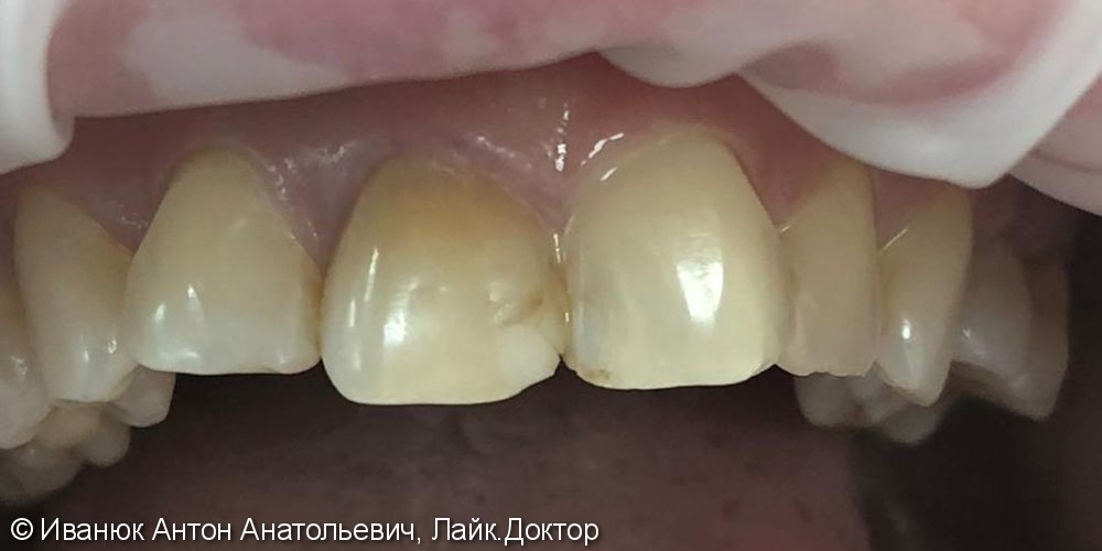 Протезирование зубов на верхней челюсти винирами из прессованной керамики E-MAX - фото №1