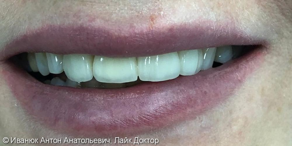 Протезирование зубов на верхней челюсти винирами из прессованной керамики E-MAX - фото №2