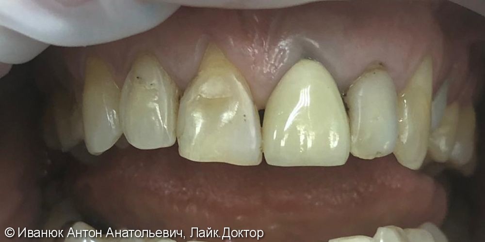 Протезирование зубов с помощью виниров из прессованной керамики E-MAX - фото №1