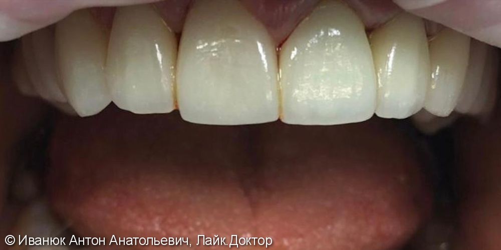 Протезирование зубов с помощью виниров из прессованной керамики E-MAX - фото №2