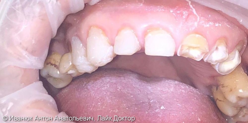 Патологическая стираемость зубов во фронтальном отделе верхней челюсти - фото №1