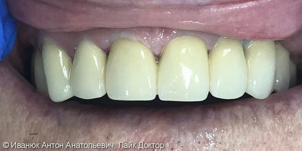 Патологическая стираемость зубов во фронтальном отделе верхней челюсти - фото №4