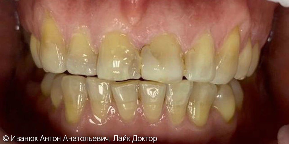 Протезирование зубов с помощью ВИНИРОВ из прессованной керамики E-MAX - фото №1