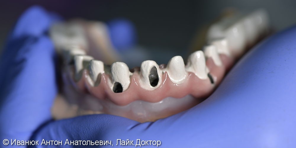 Восстановление зубного ряда нижней и верхней челюстях при полной адентии - фото №1