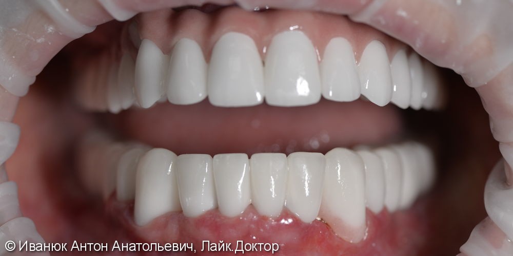 Восстановление зубного ряда нижней и верхней челюстях при полной адентии - фото №7