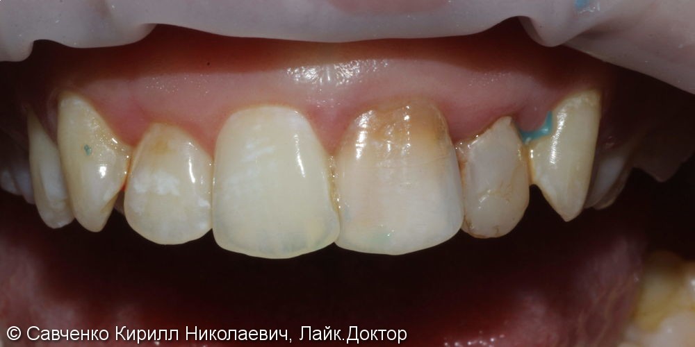 Протезирование зубов фронтального отдела с помощью виниров из прессованной керамики e-max - фото №1