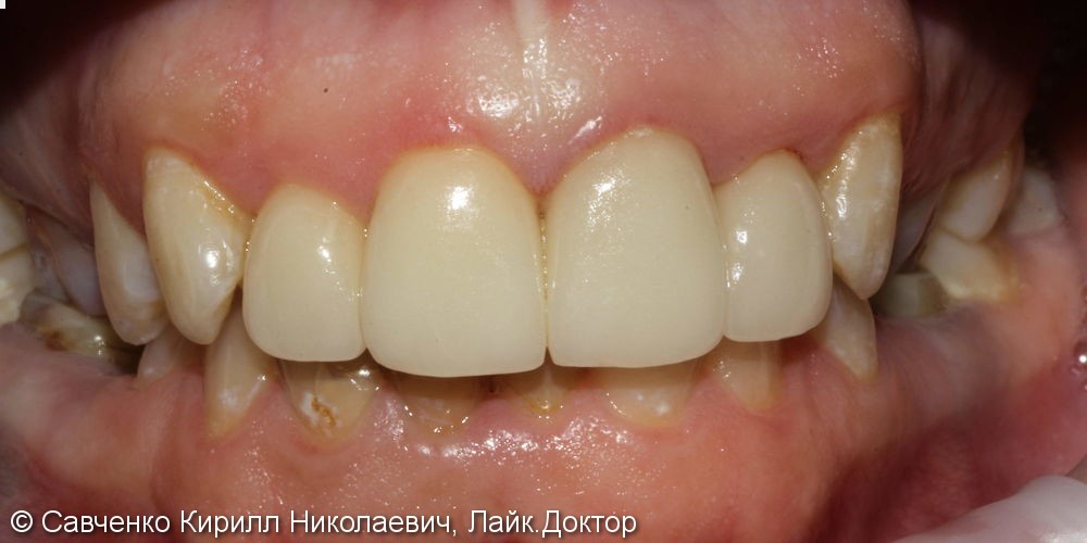 Протезирование зубов фронтального отдела с помощью виниров из прессованной керамики e-max - фото №2