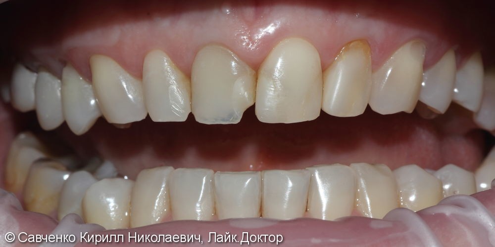 Протезирование зубов фронтального отдела с помощью виниров из прессованной керамики E-MAX - фото №1