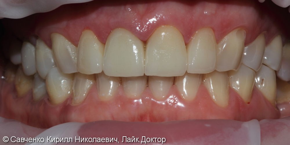 Протезирование зубов фронтального отдела с помощью виниров из прессованной керамики E-MAX - фото №2