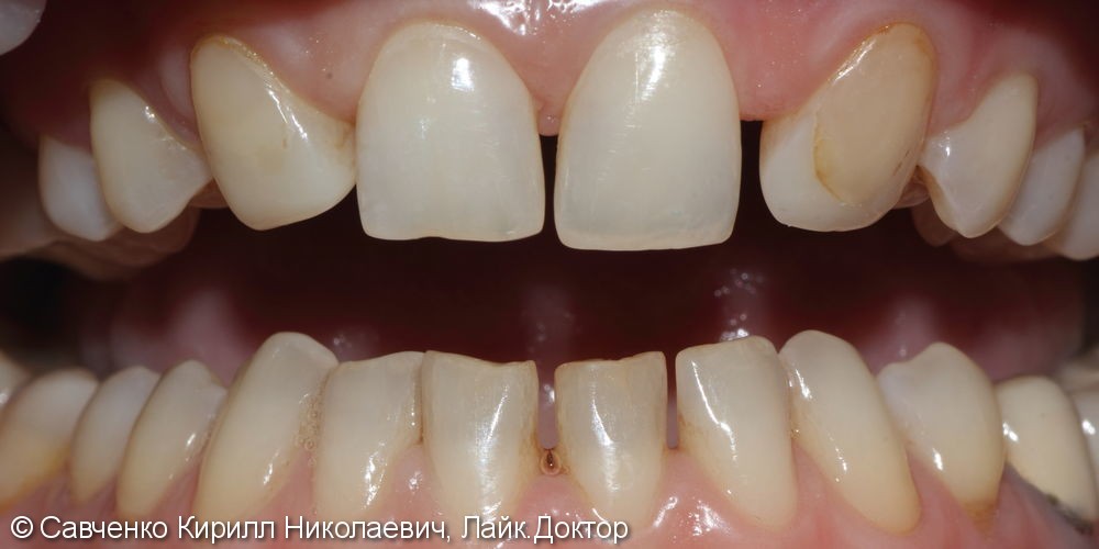 Протезирование зубов с помощью виниров из прессованной керамики E-MAX - фото №1
