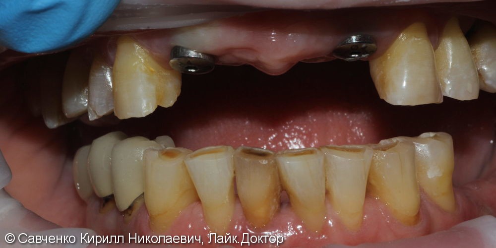 Установка 2 имплантатов и протезирование передних зубов - фото №1