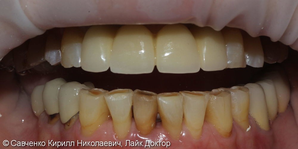 Установка 2 имплантатов и протезирование передних зубов - фото №2