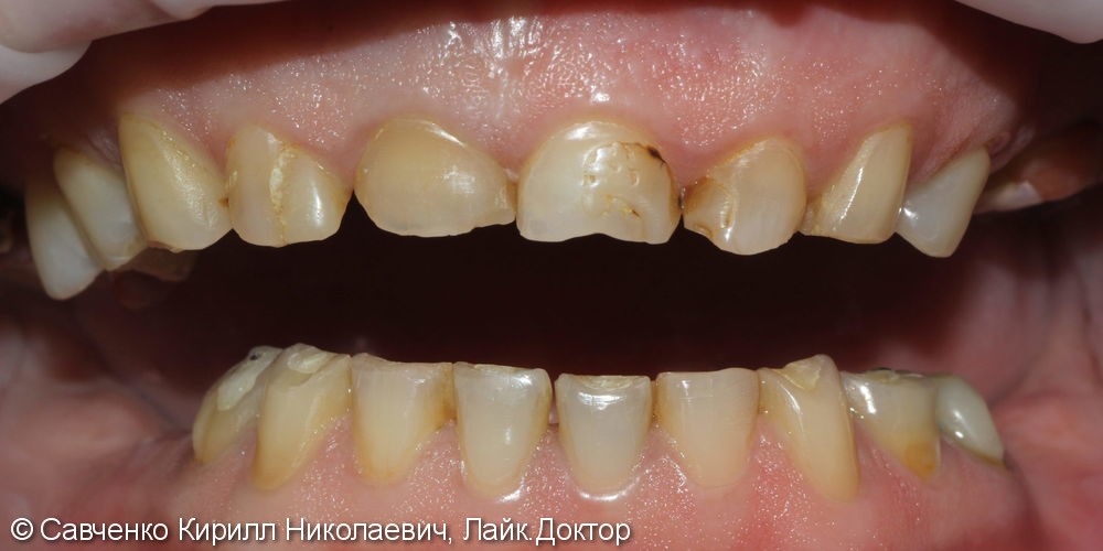 Проблемы со стираемостью зубов во фронтальном отделе на верхней и нижней челюстях - фото №1