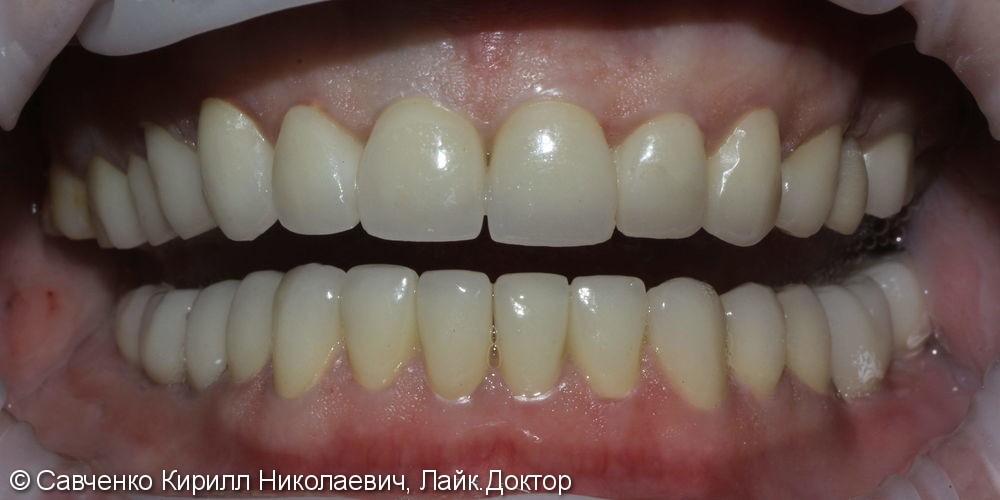 Проблемы со стираемостью зубов во фронтальном отделе на верхней и нижней челюстях - фото №2