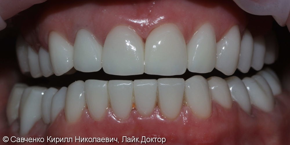 Реставрация абсолютно всех зубов - фото №2