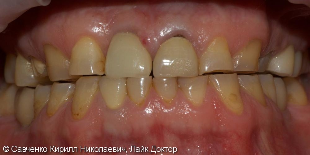 Патологическая стираемостью зубов на верхней и нижней челюстях - фото №1