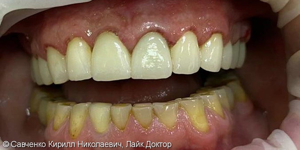 Патологическая стираемостью зубов на верхней и нижней челюстях - фото №2