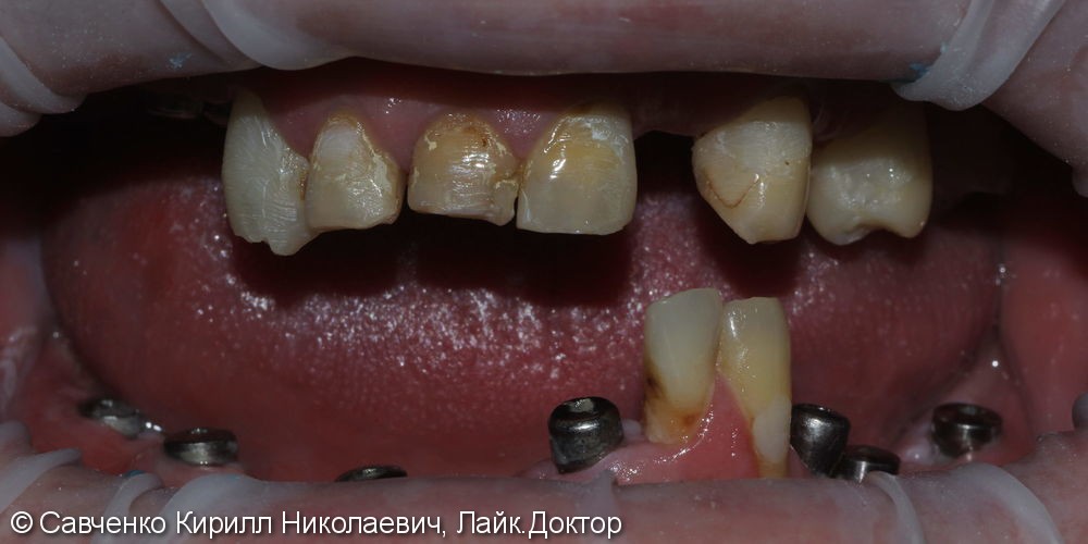 Восстановление зубного ряда 2х челюстей с помощью имплантантов и проведение костной пластики - фото №1