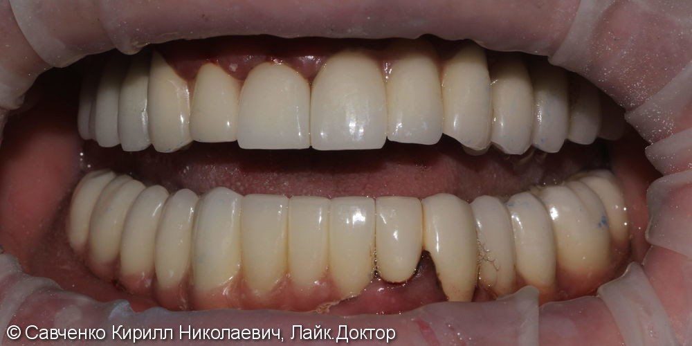 Восстановление зубного ряда 2х челюстей с помощью имплантантов и проведение костной пластики - фото №2
