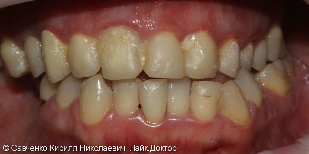Протезирование зубов с помощью ВИНИРОВ из прессованной керамики E-MAX - фото №1